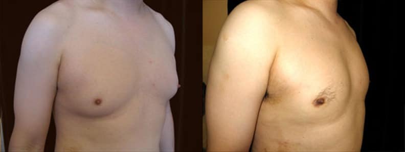 Gynecomastia Patient 21 Before & After Details