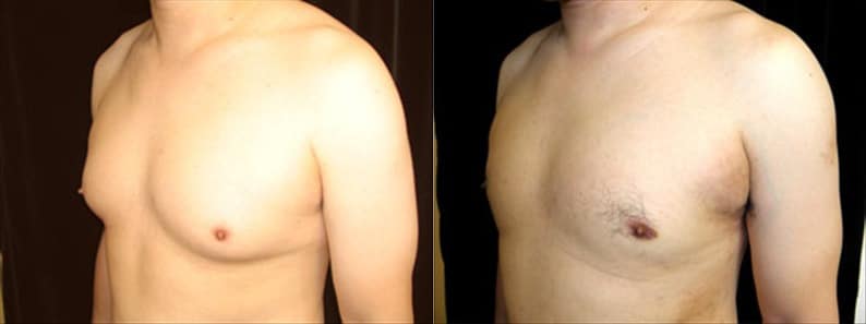 Gynecomastia Patient 21 Before & After Details