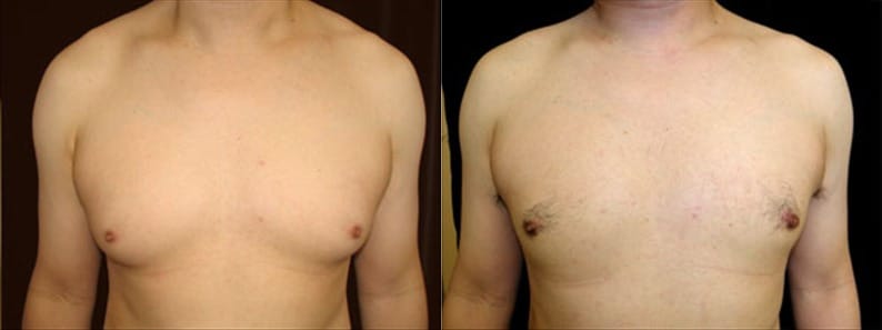 Gynecomastia Patient 21 Before & After