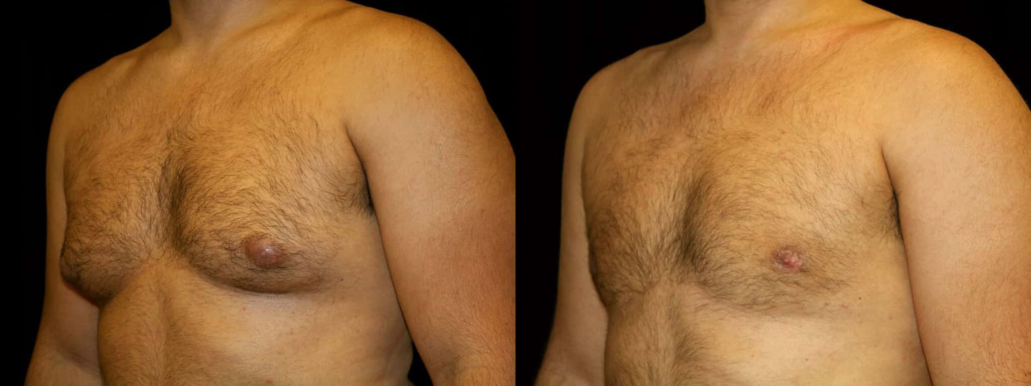 Gynecomastia Patient 11 Before & After Details