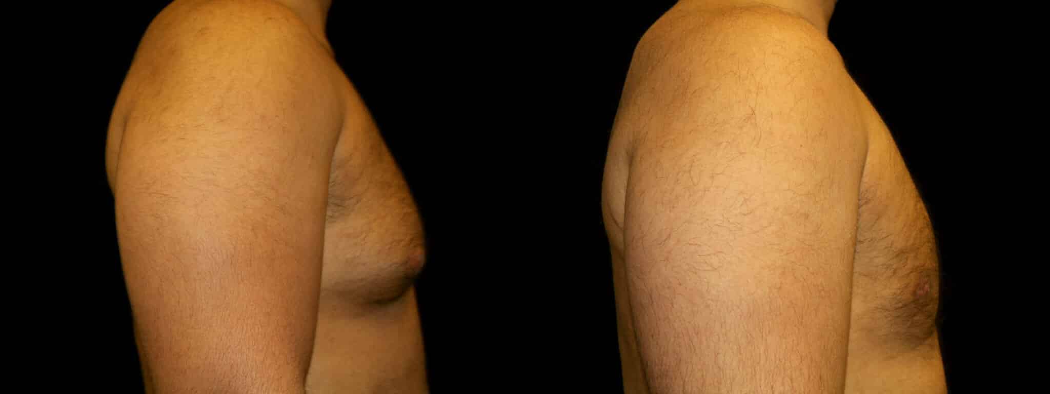 Gynecomastia Patient 11 Before & After Details