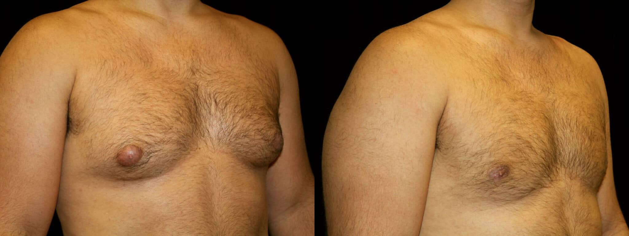 Gynecomastia Patient 11 Before & After Details