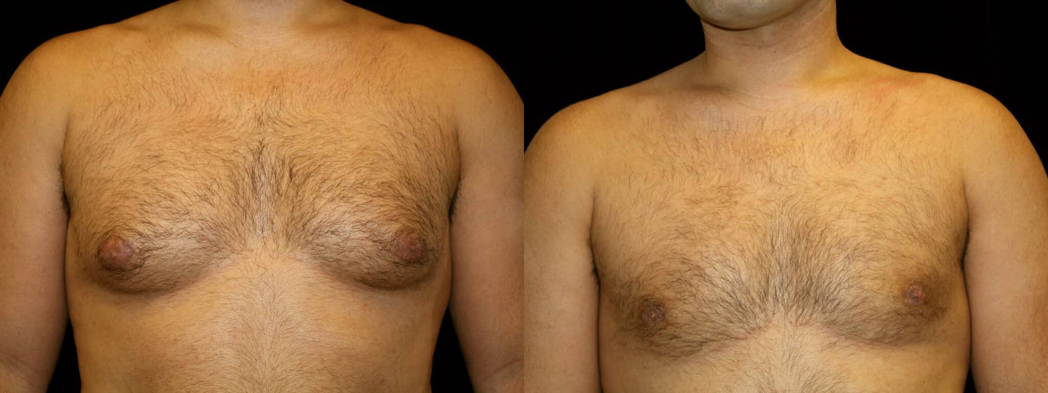 Gynecomastia Patient 11 Before & After