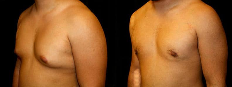 Gynecomastia Patient 5 Before & After Details