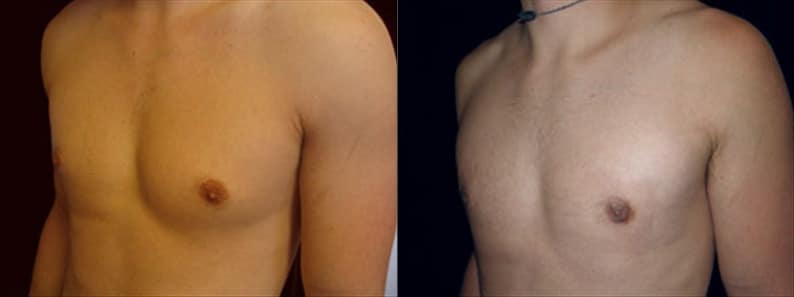 Gynecomastia Patient 5 Before & After Details