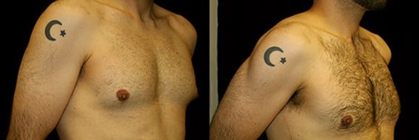 Gynecomastia Patient 1 Before & After Details