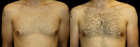 Gynecomastia Patient 1 Before & After