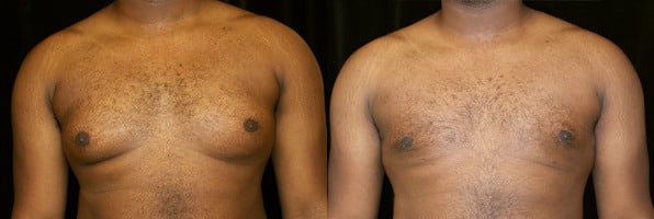 Gynecomastia Patient 19 Before & After