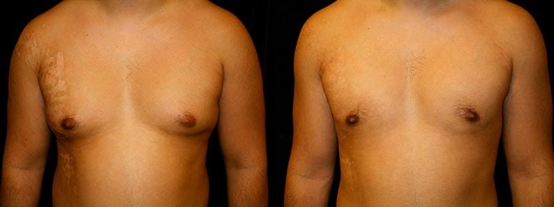 Gynecomastia Patient 5 Before & After