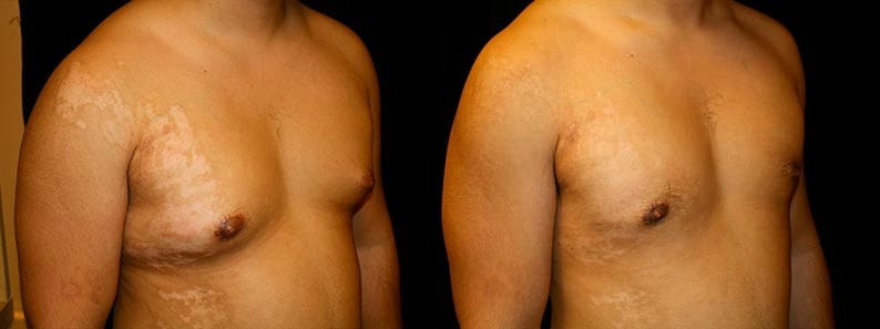Gynecomastia Patient 5 Before & After Details