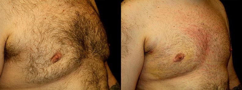 Gynecomastia Patient 4 Before & After Details