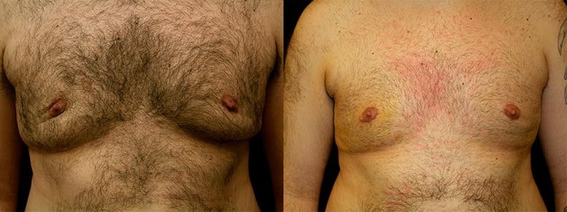 Gynecomastia Patient 4 Before & After