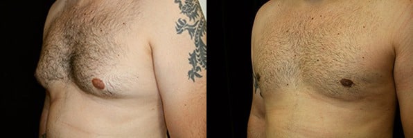 Gynecomastia Patient 17 Before & After Details