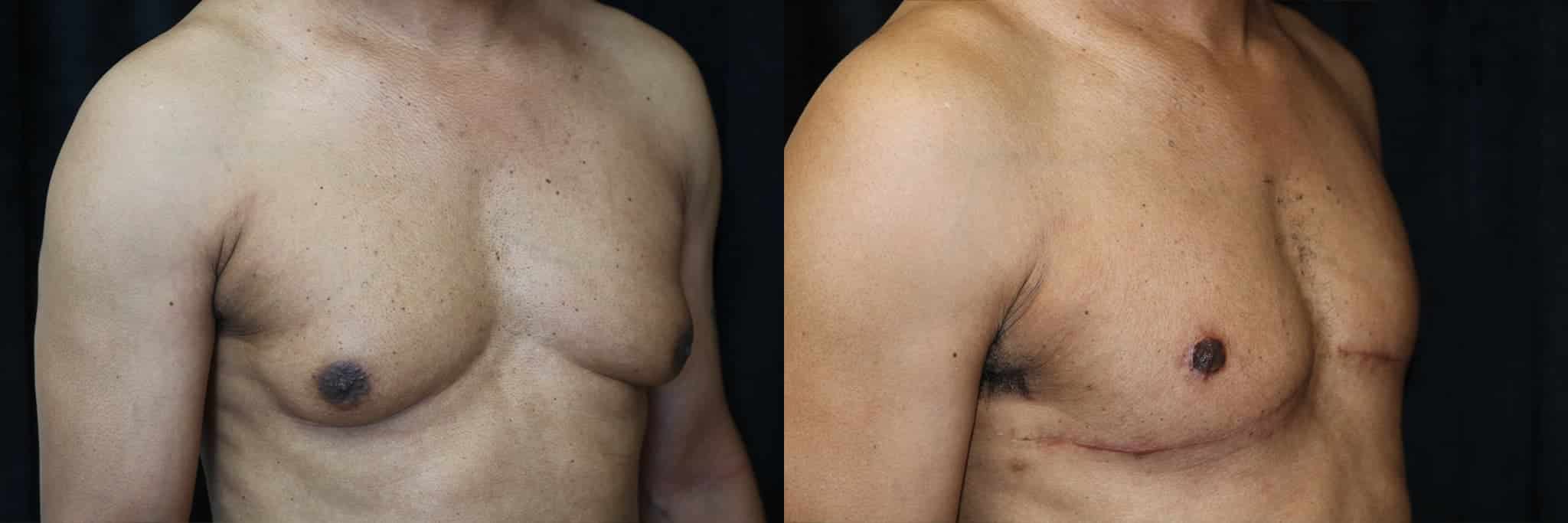 Gynecomastia Patient 4 Before & After Details