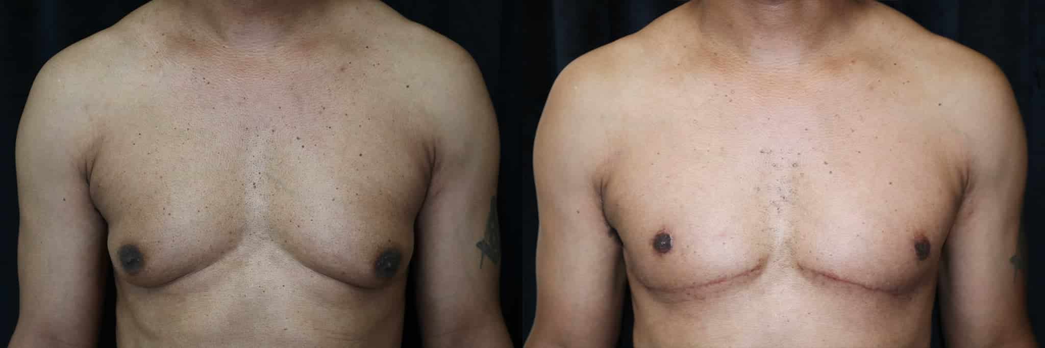 Gynecomastia Patient 4 Before & After