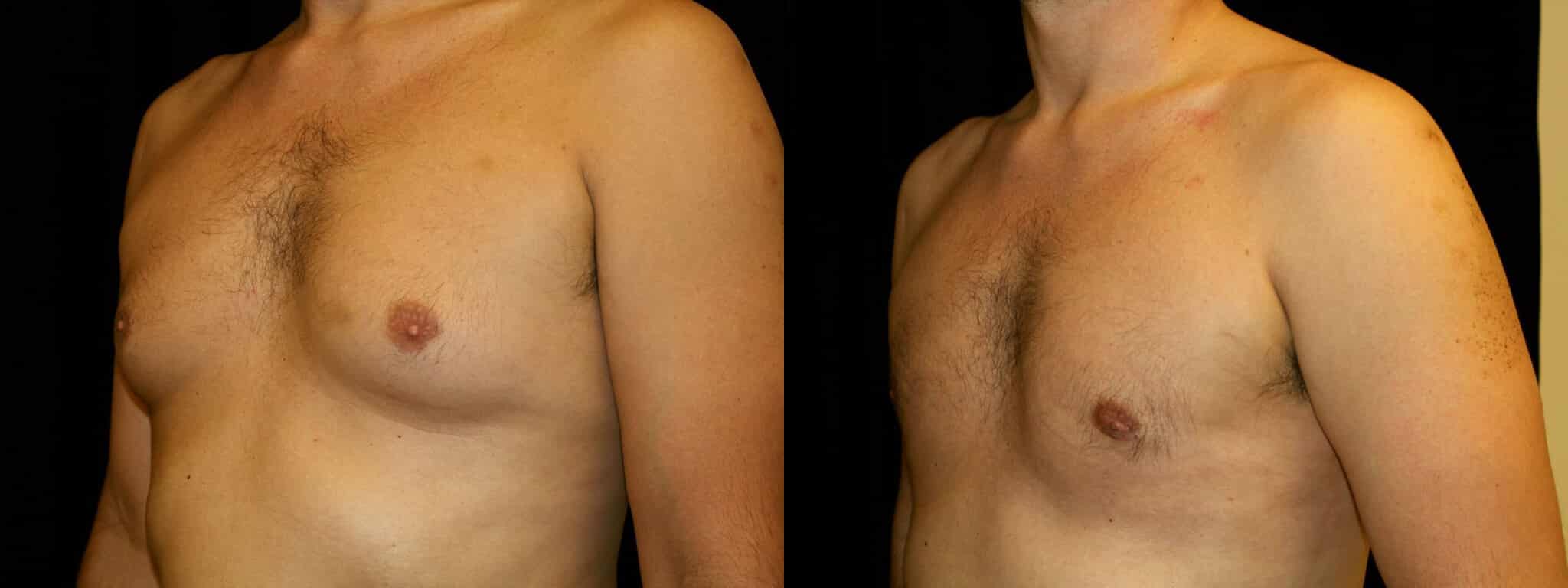 Gynecomastia Patient 14 Before & After Details