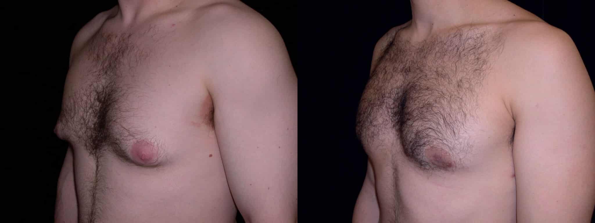 Gynecomastia Patient 4 Before & After Details