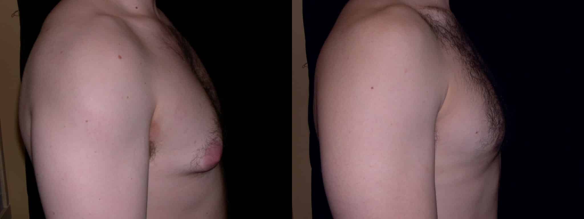 Gynecomastia Patient 4 Before & After Details
