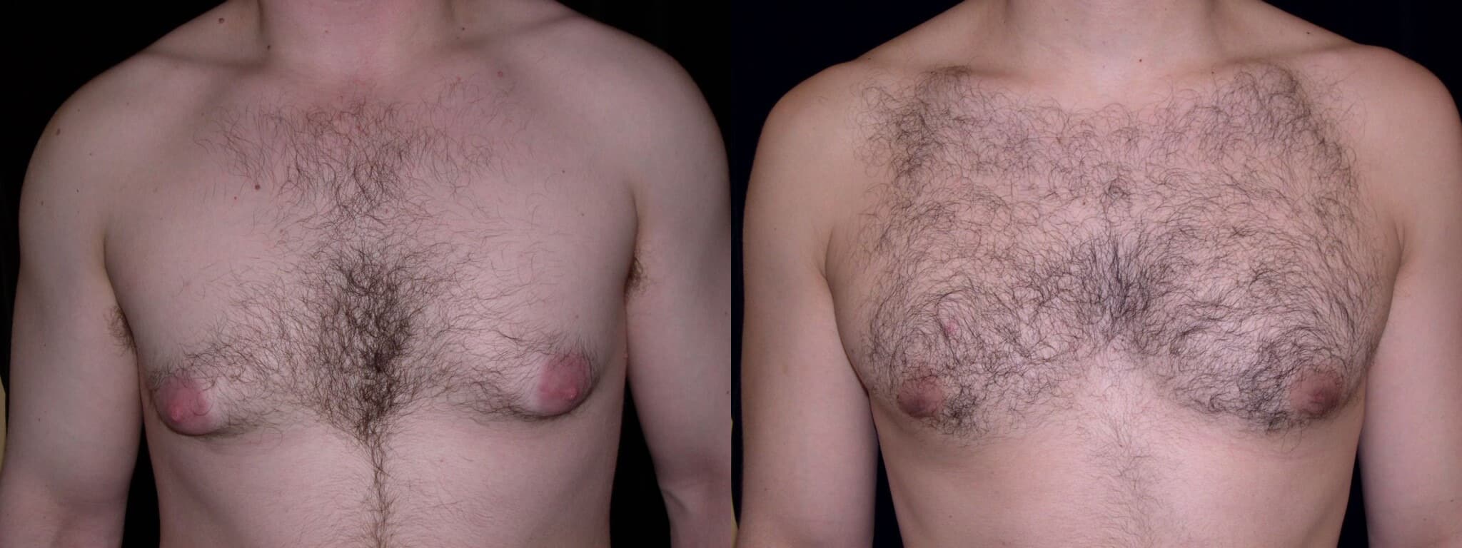 Gynecomastia Patient 4 Before & After