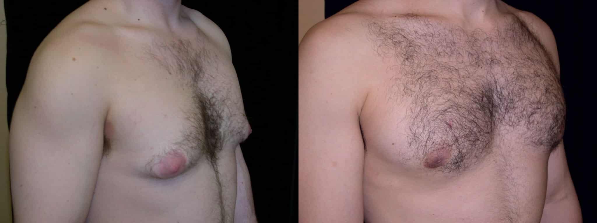 Gynecomastia Patient 4 Before & After Details