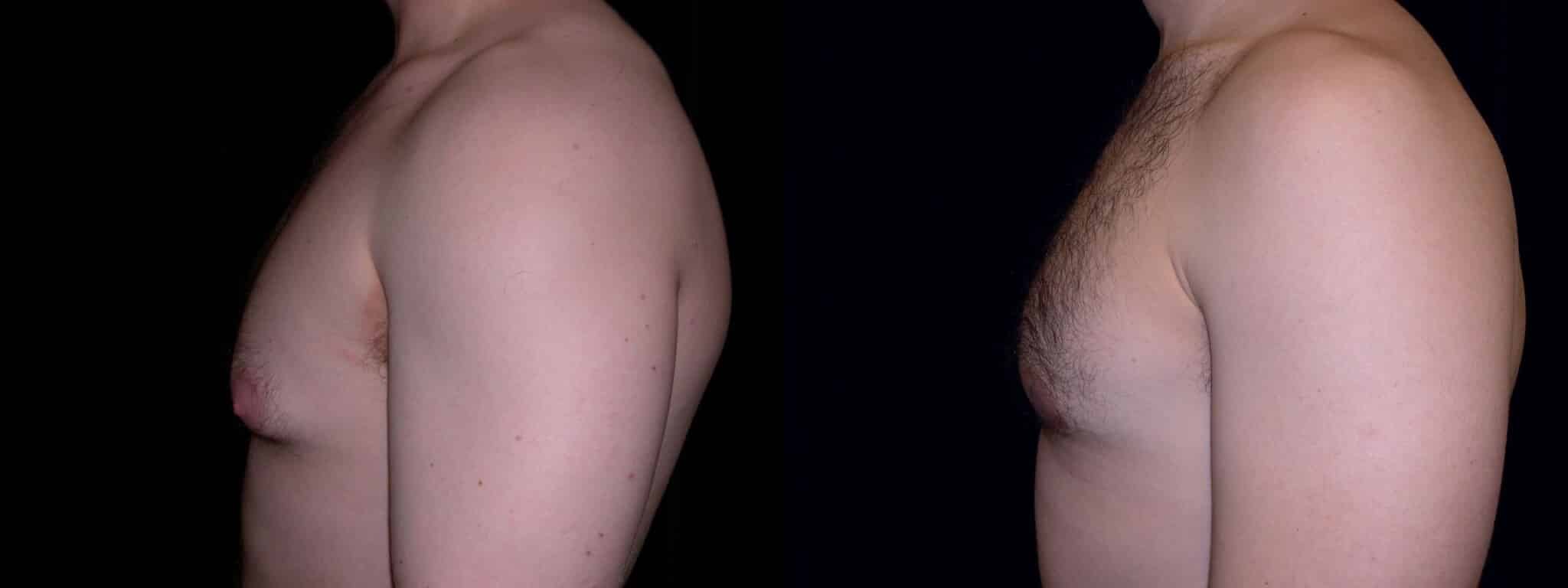 Gynecomastia Patient 4 Before & After Details