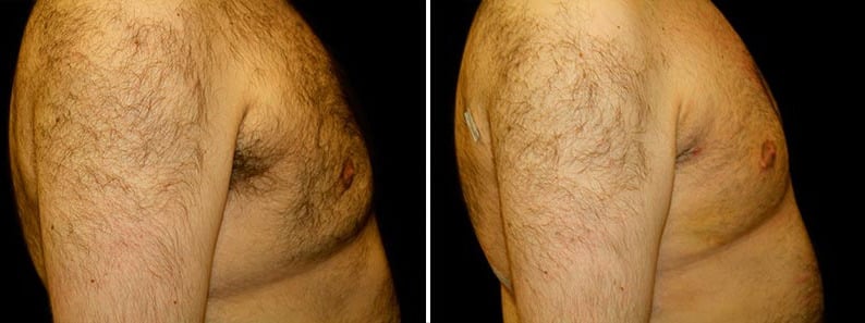 Gynecomastia Patient 4 Before & After Details