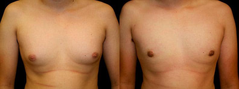 Gynecomastia Patient 4 Before & After