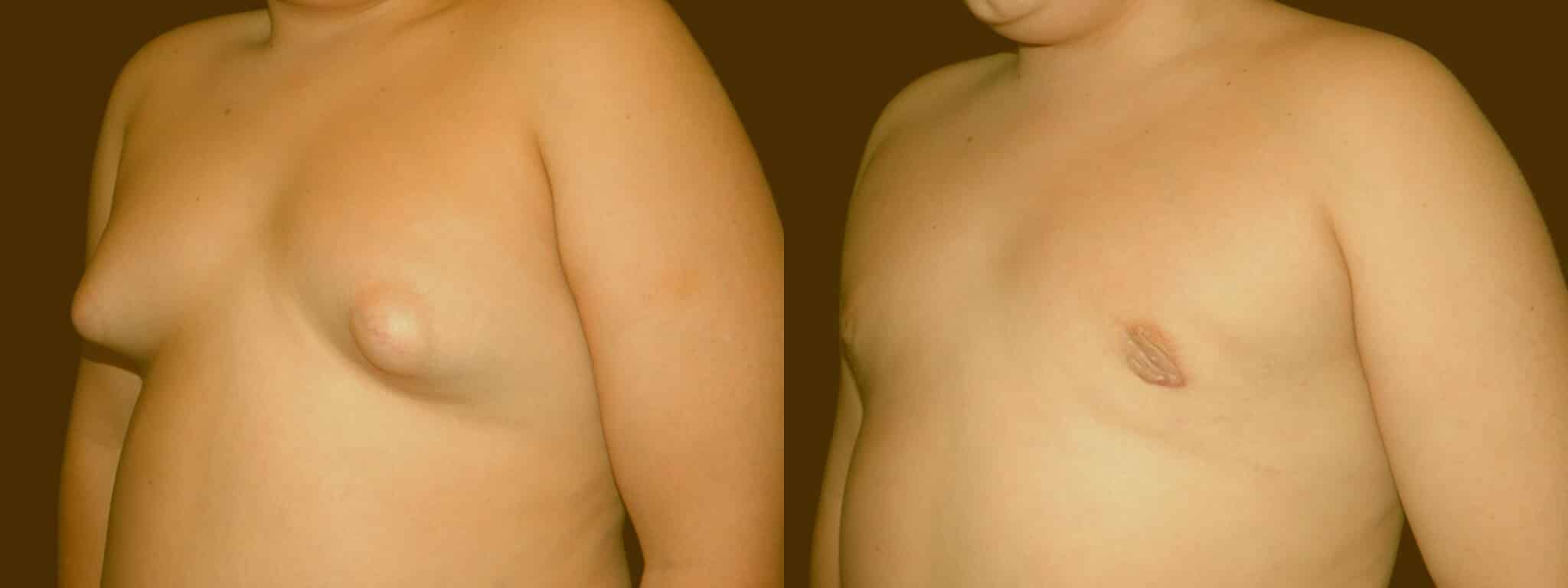 Gynecomastia Patient 13 Before & After Details