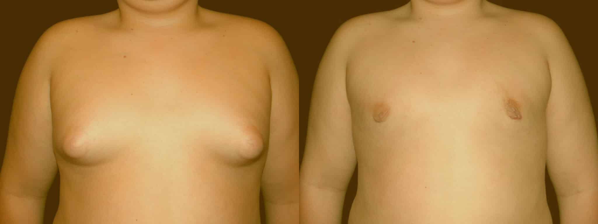 Gynecomastia Patient 13 Before & After