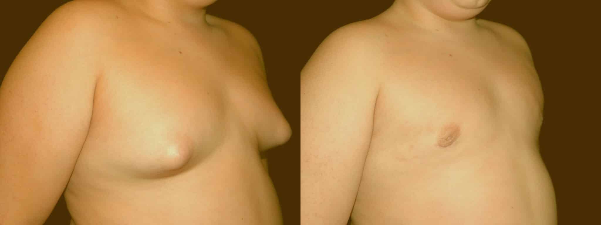 Gynecomastia Patient 13 Before & After Details