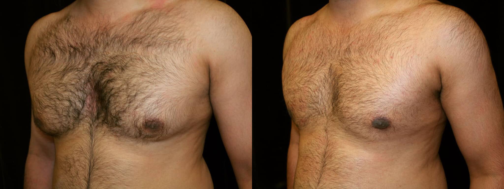 Gynecomastia Patient 2 Before & After Details