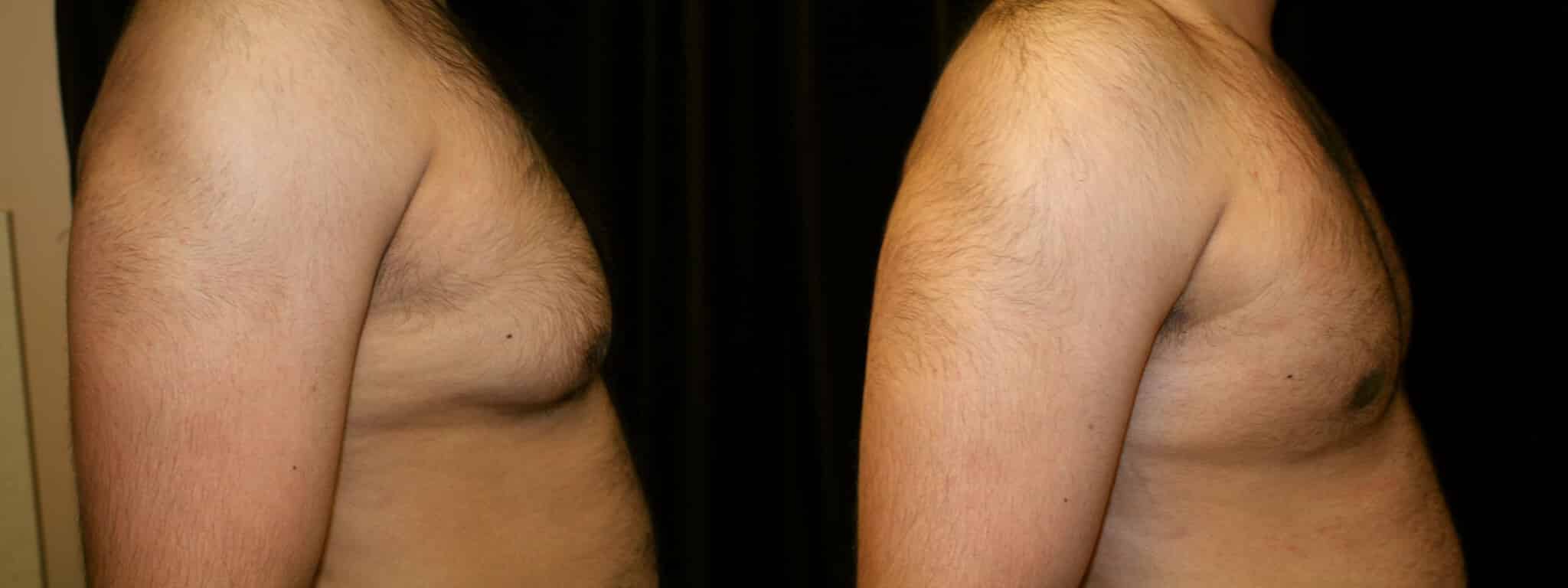 Gynecomastia Patient 2 Before & After Details