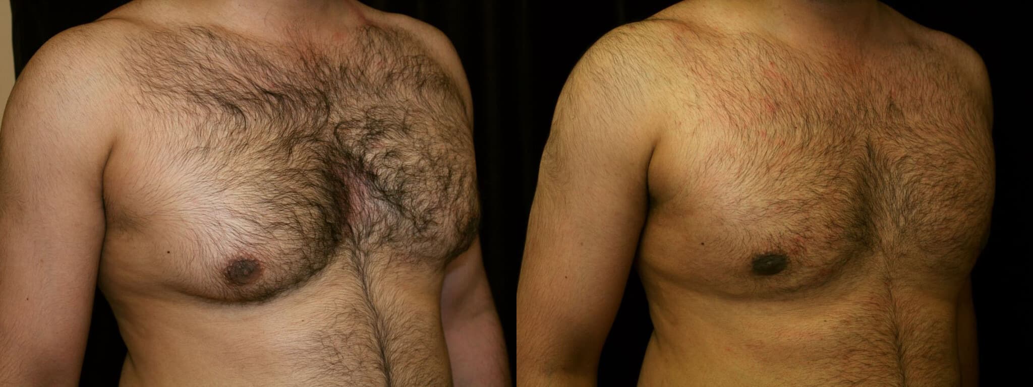 Gynecomastia Patient 2 Before & After Details