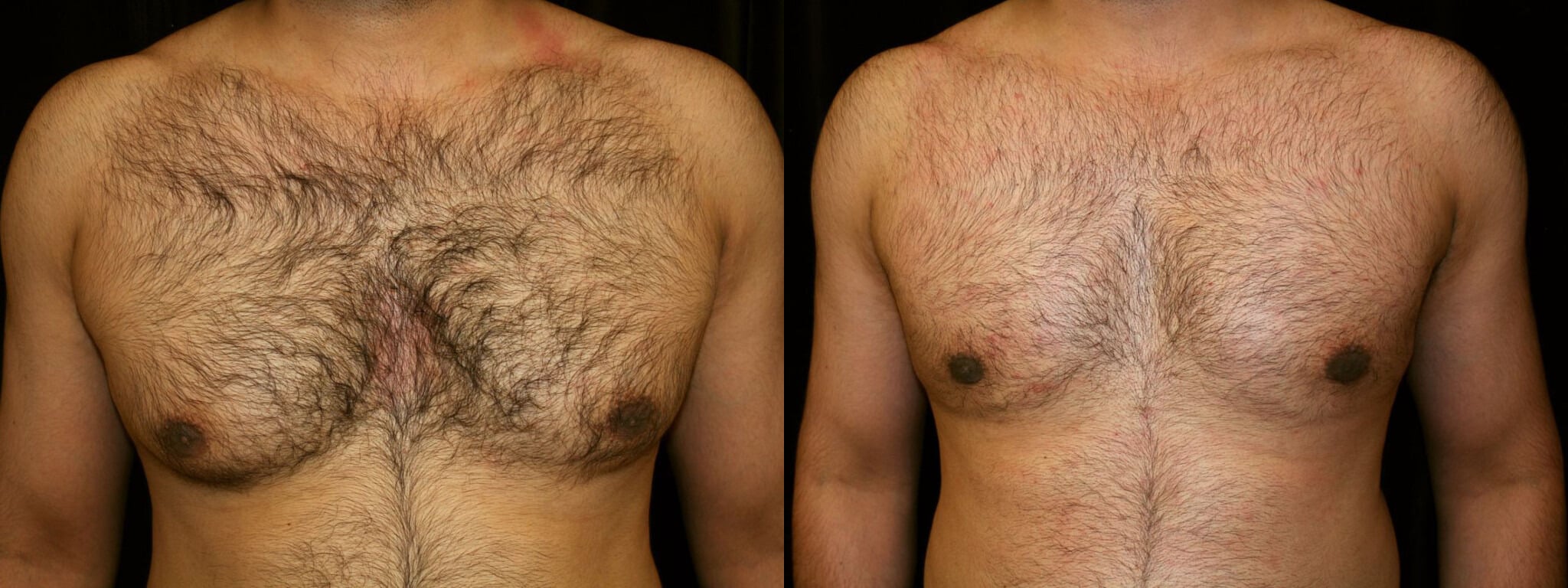 Gynecomastia Patient 2 Before & After