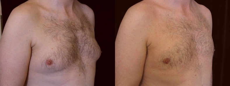 Gynecomastia Patient 17 Before & After