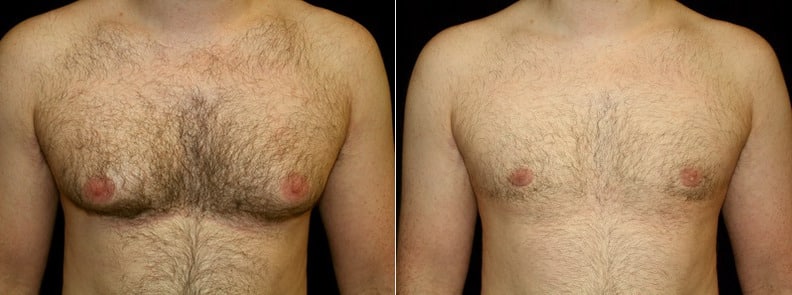 Gynecomastia Patient 10 Before & After