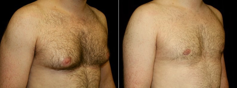 Gynecomastia Patient 10 Before & After Details