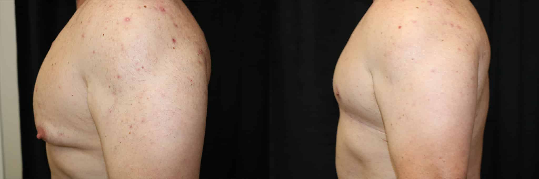 Gynecomastia Patient 21 Before & After Details