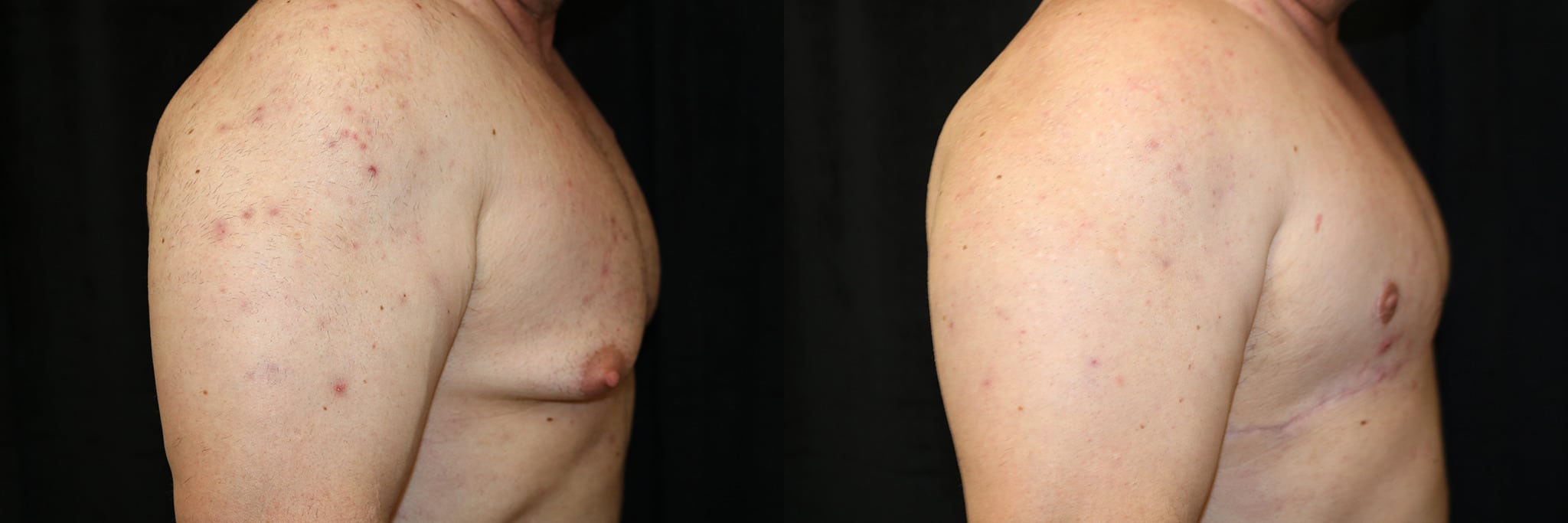 Gynecomastia Patient 21 Before & After Details