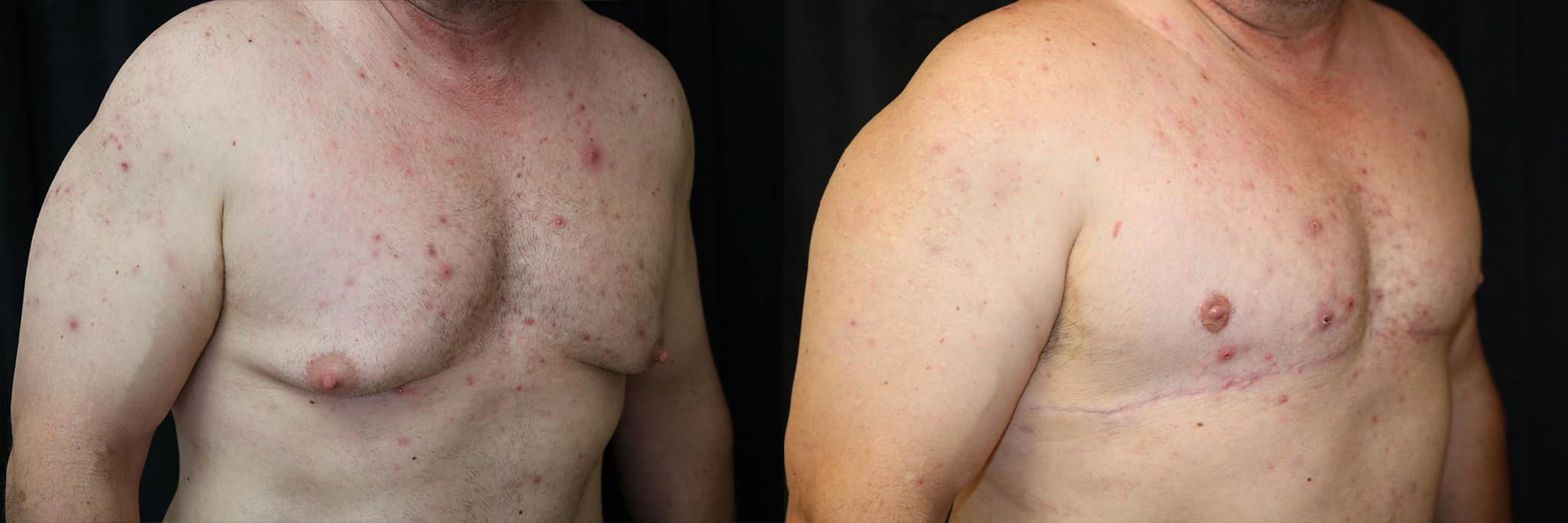 Gynecomastia Patient 21 Before & After Details