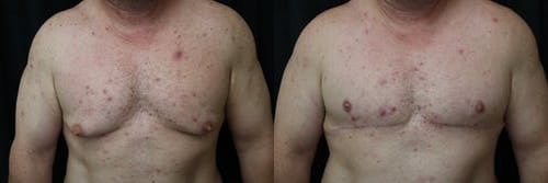 Gynecomastia Patient 21 Before & After