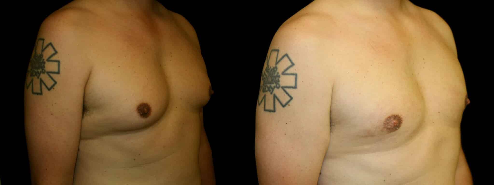Gynecomastia Patient 11 Before & After Details