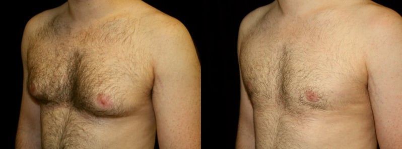 Gynecomastia Patient 10 Before & After Details