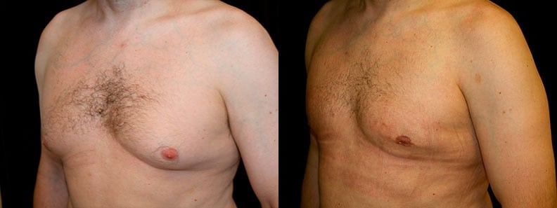 Gynecomastia Patient 15 Before & After Details