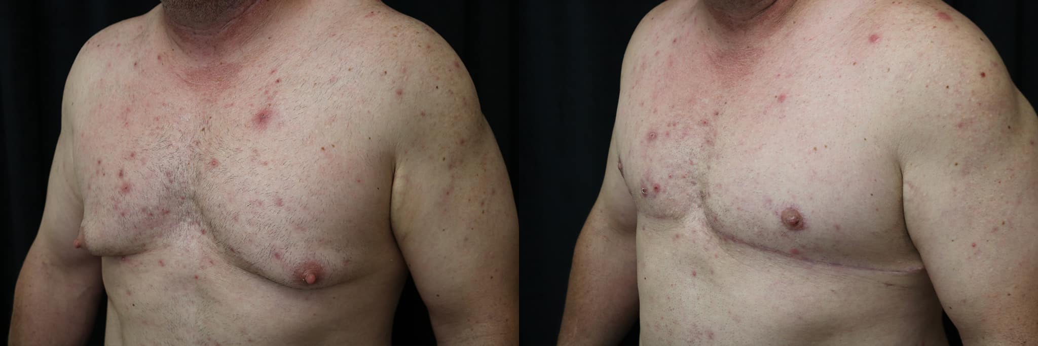 Gynecomastia Patient 21 Before & After Details