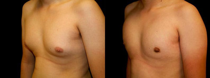 Gynecomastia Patient 4 Before & After Details