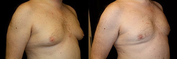 Gynecomastia Patient 15 Before & After Details