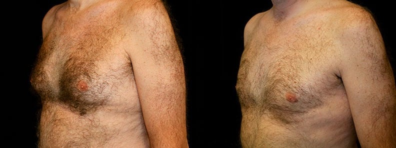 Gynecomastia Patient 3 Before & After Details