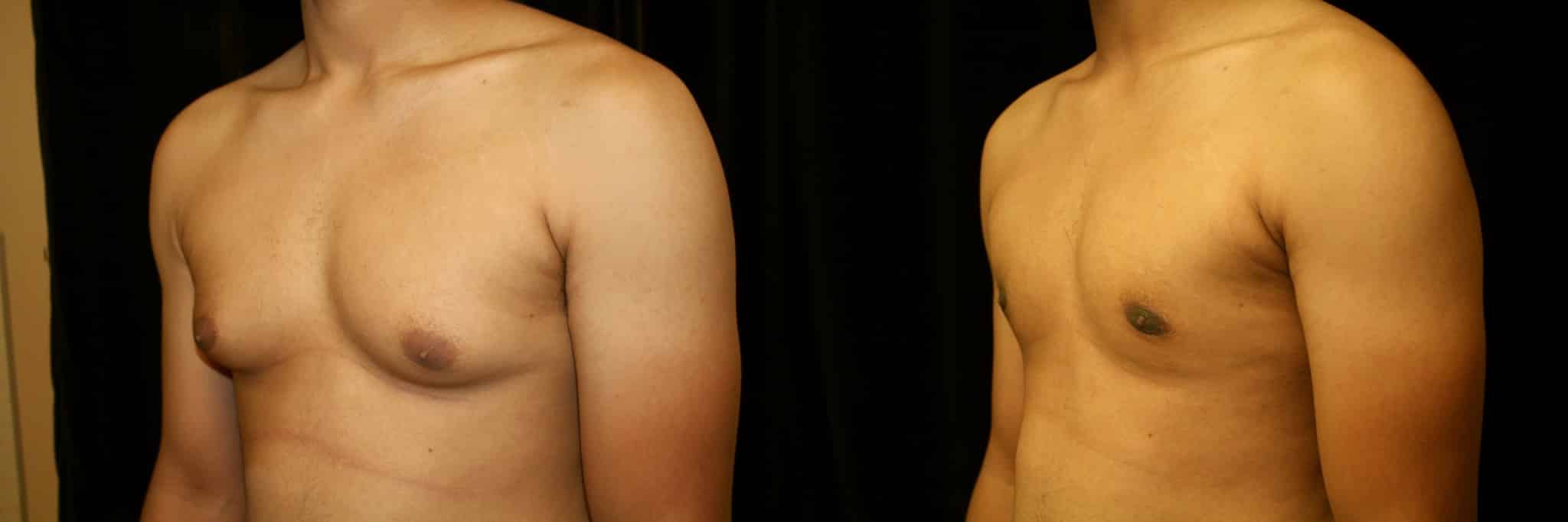 Gynecomastia Patient 2 Before & After Details