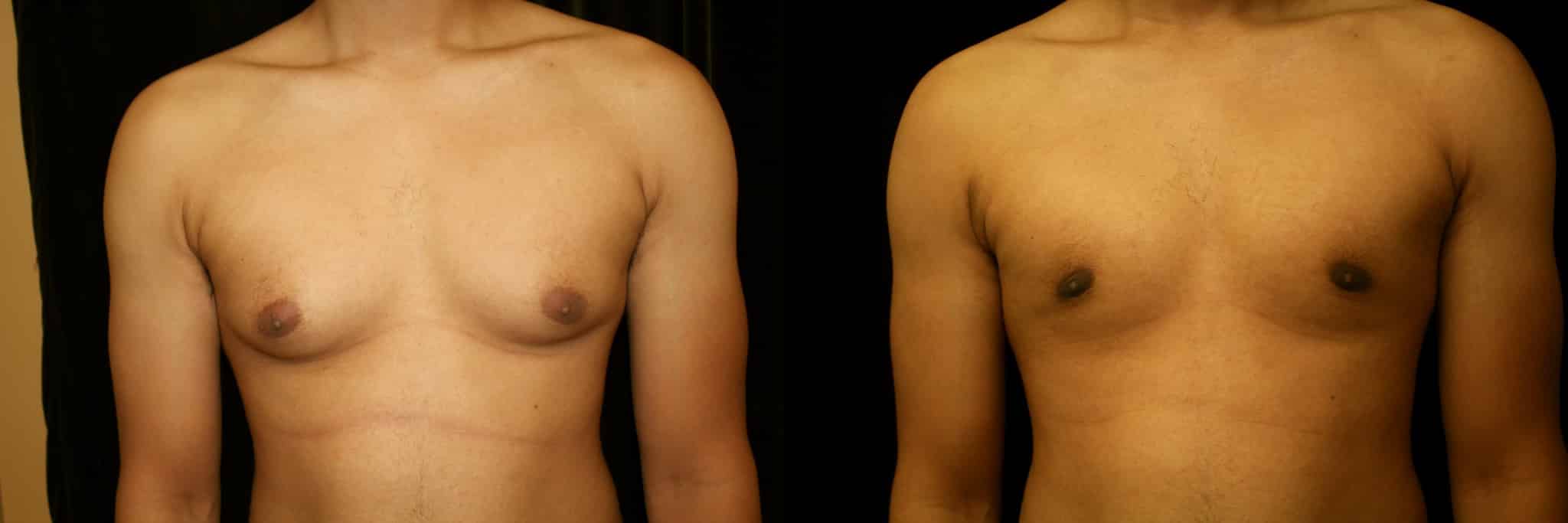 Gynecomastia Patient 2 Before & After